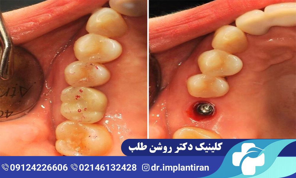 هیلینگ ایمپلنت