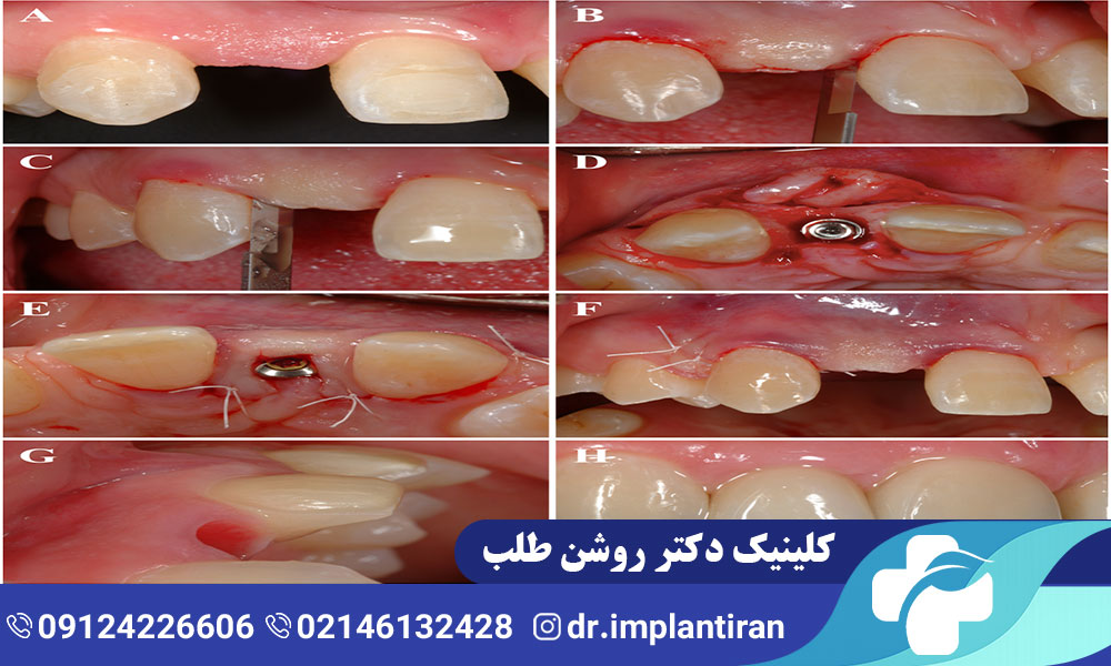 هیلینگ ایمپلنت