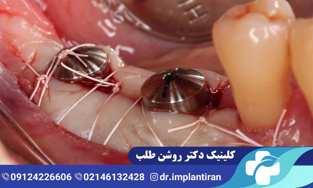 حرف زدن بعد از جراحی ایمپلنت