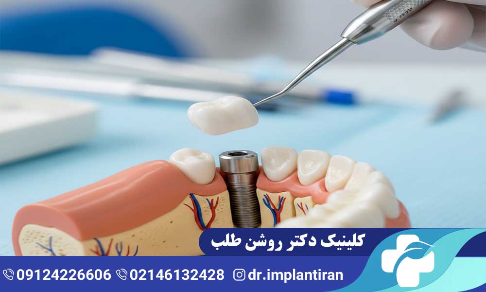 حرف زدن بعد از جراحی ایمپلنت