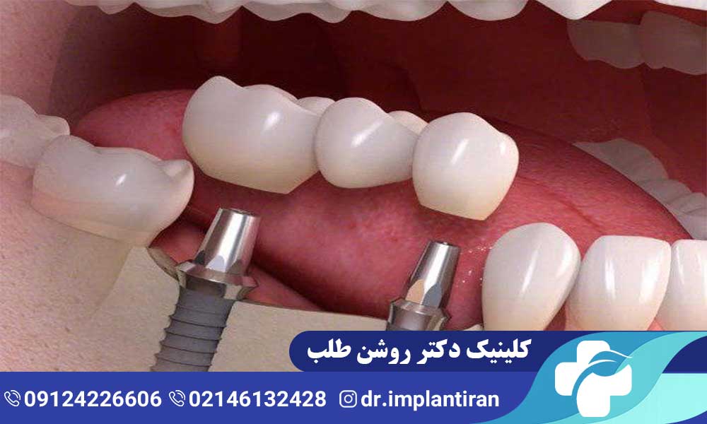 حرف زدن بعد از جراحی ایمپلنت