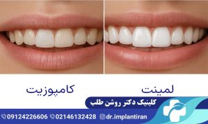 لمینت سرامیکی یا کامپوزیت