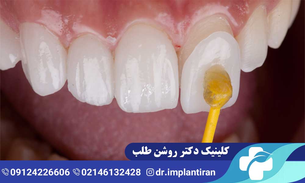 لمینت سرامیکی یا کامپوزیت