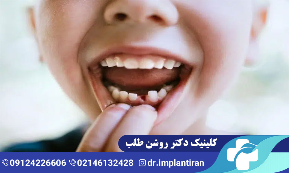 علت دیر افتادن دندان شیری