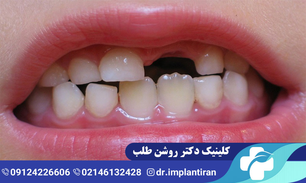 علت دیر افتادن دندان شیری