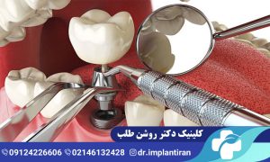 ایمپلنت فک پایین