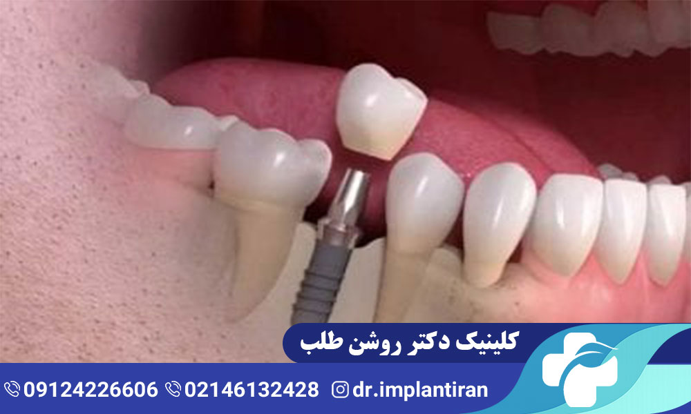 ایمپلنت فک پایین