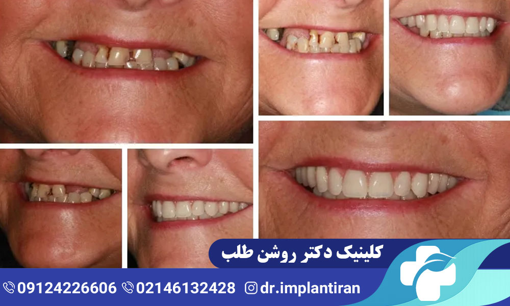 ایمپلنت فک پایین