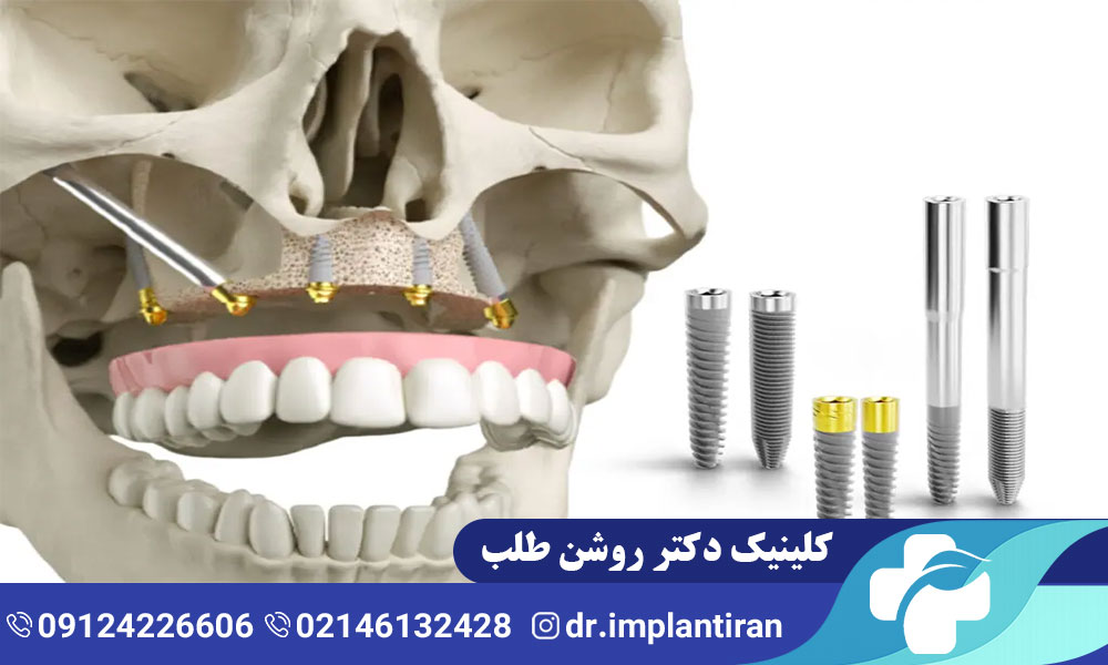 ایمپلنت فک بالا