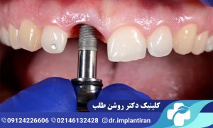 ایمپلنت فک بالا