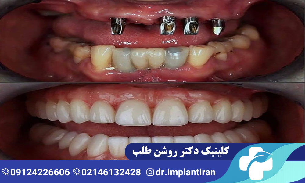 ایمپلنت فک بالا