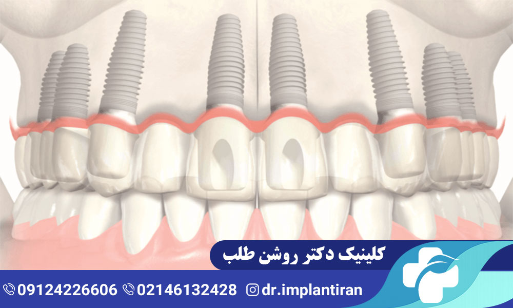 ایمپلنت فک بالا