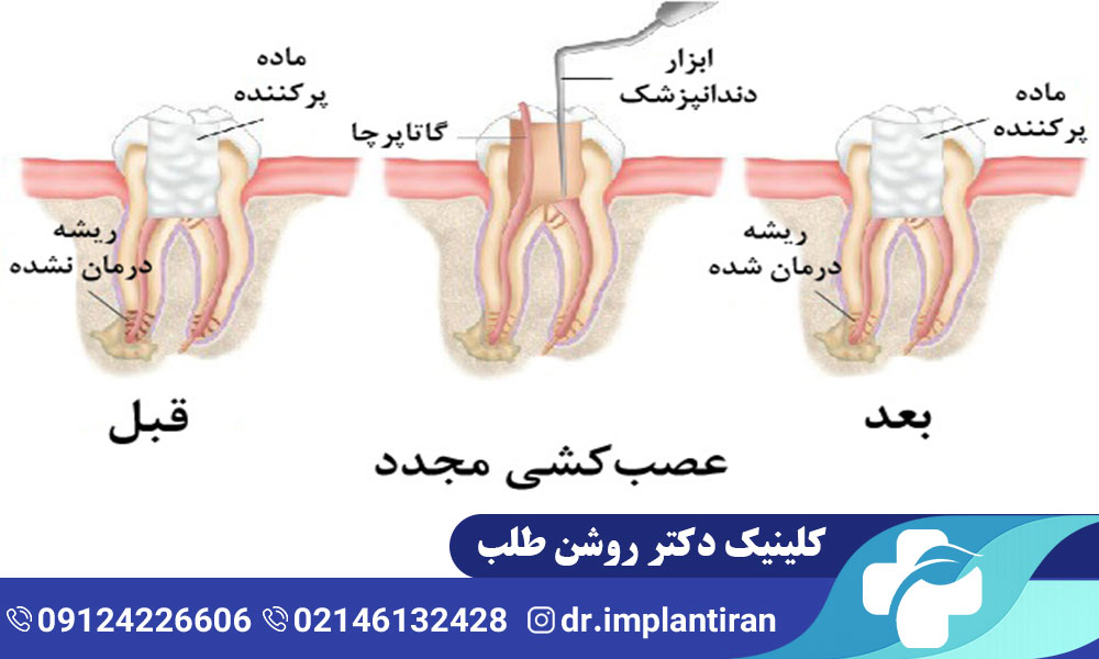 عصب کشی مجدد دندان