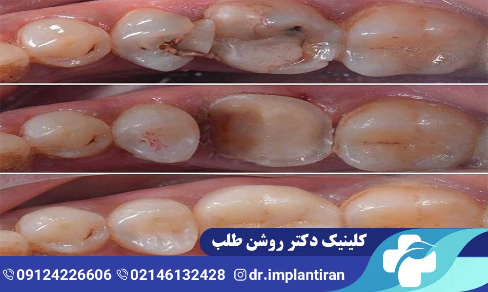 عصب کشی مجدد دندان