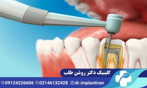 عصب کشی مجدد دندان