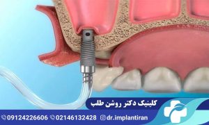 جراحی سینوس لیفت باز