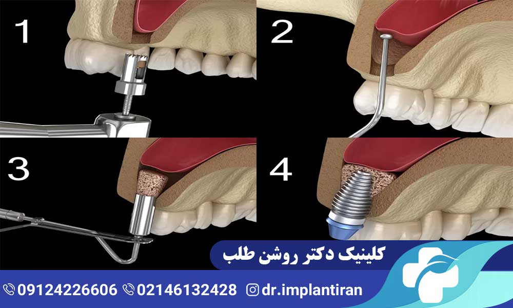 جراحی سینوس لیفت باز