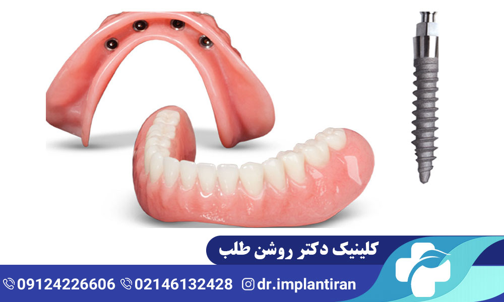 فرق اوردنچر با ایمپلنت