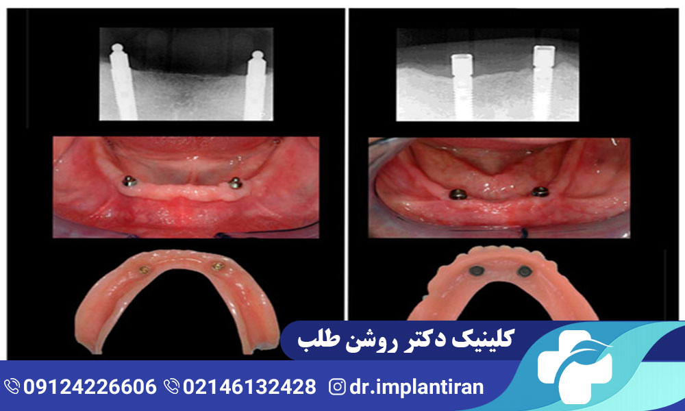 فرق اوردنچر با ایمپلنت