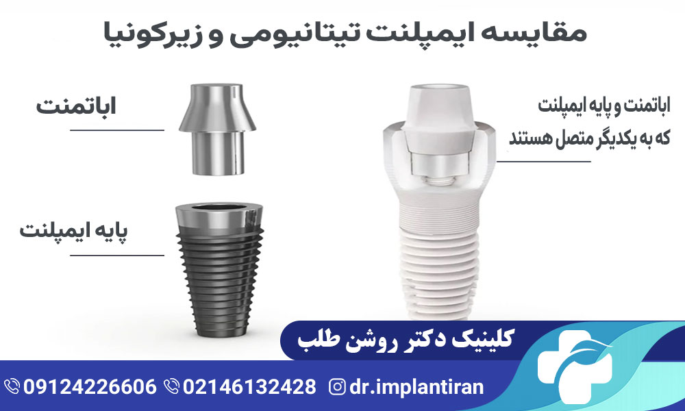 تفاوت ایمپلنت تیتانیومی و زیرکونیا