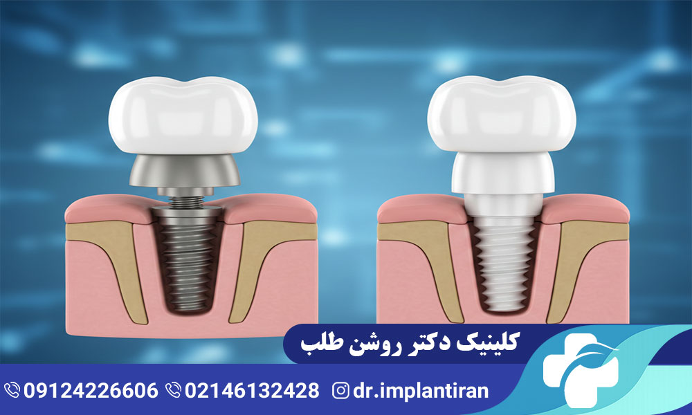 ایمپلنت تیتانیومی و زیرکونیا