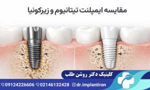 تفاوت ایمپلنت تیتانیومی و زیرکونیا