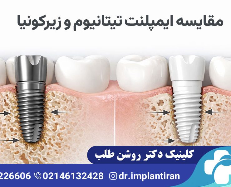 تفاوت ایمپلنت تیتانیومی و زیرکونیا