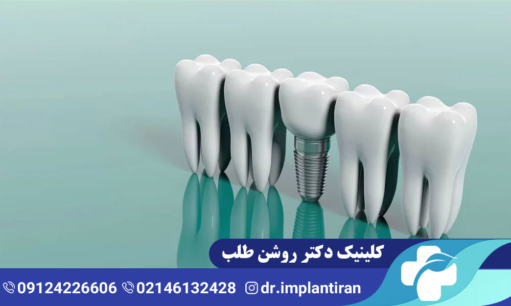 ایمپلنت تیتانیوم