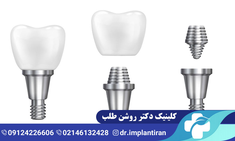 ایمپلنت تیتانیوم