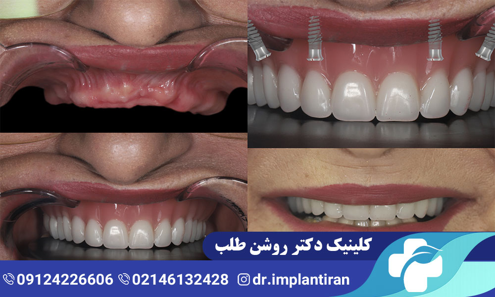 تفاوت ایمپلنت فک بالا و پایین