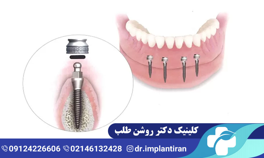 تفاوت ایمپلنت فک بالا و پایین