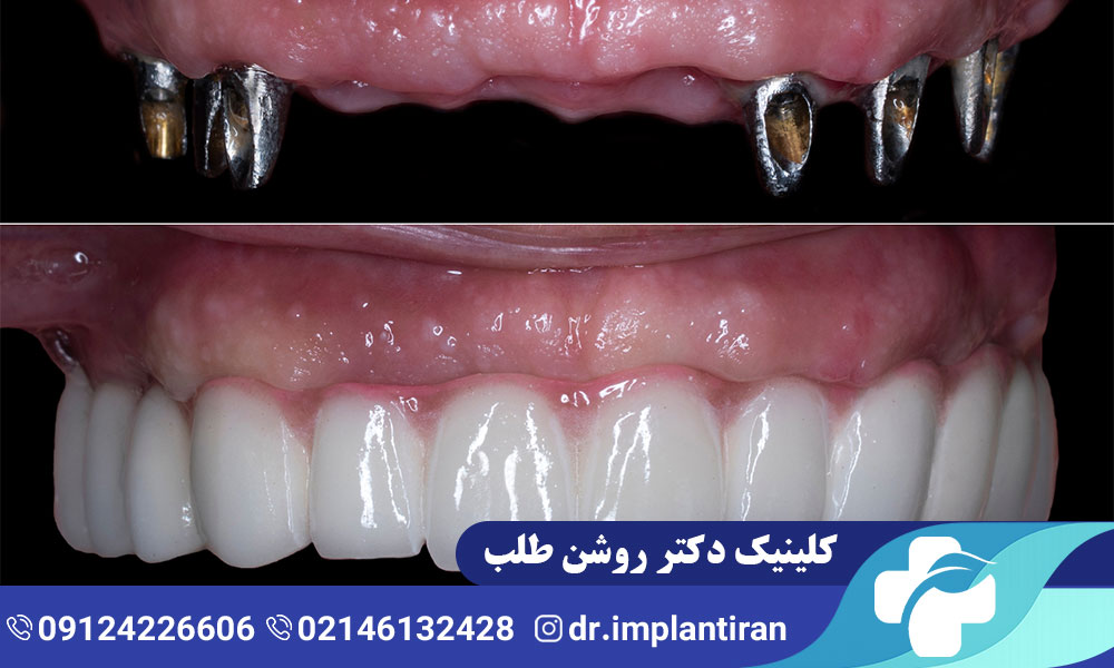 تفاوت ایمپلنت فک بالا و پایین