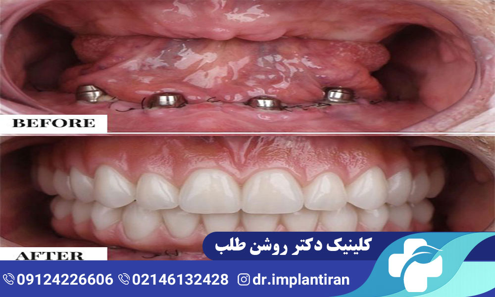 تفاوت ایمپلنت فک بالا و پایین