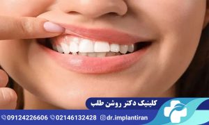 ایمپلنت فک بالا و فک پایین