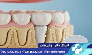 ایمپلنت زیرکونیا