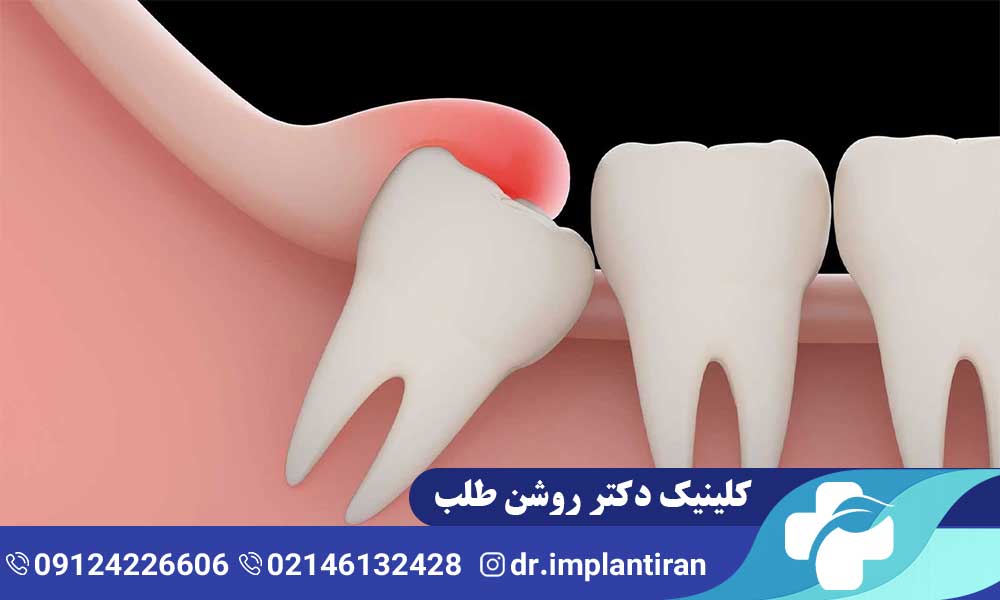 درد دندان عقل