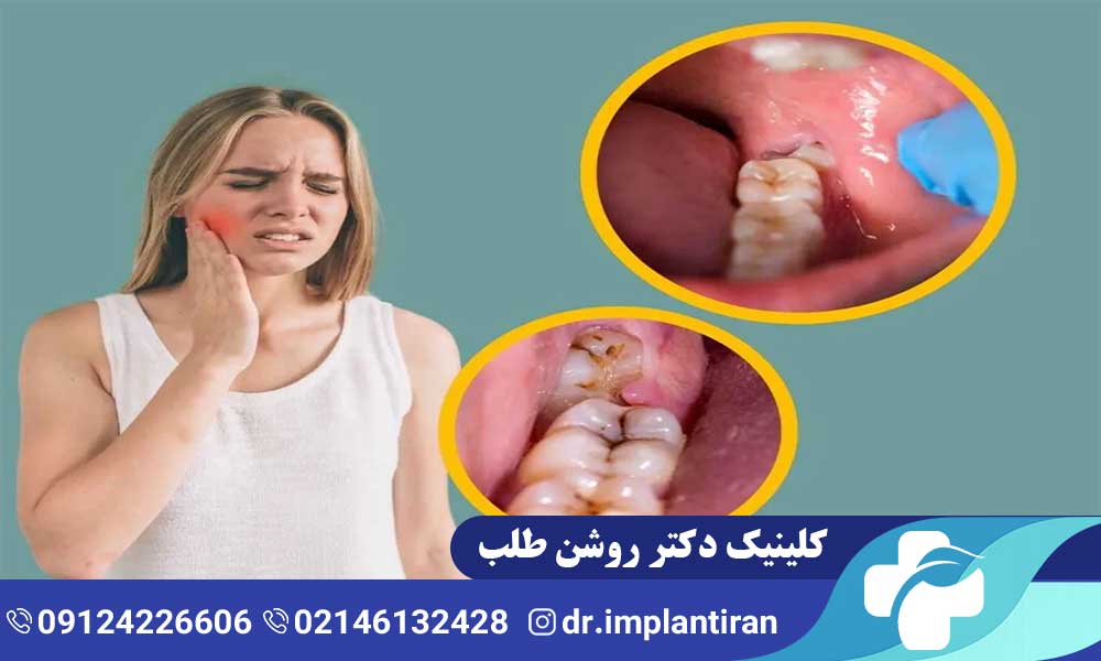 درد دندان عقل