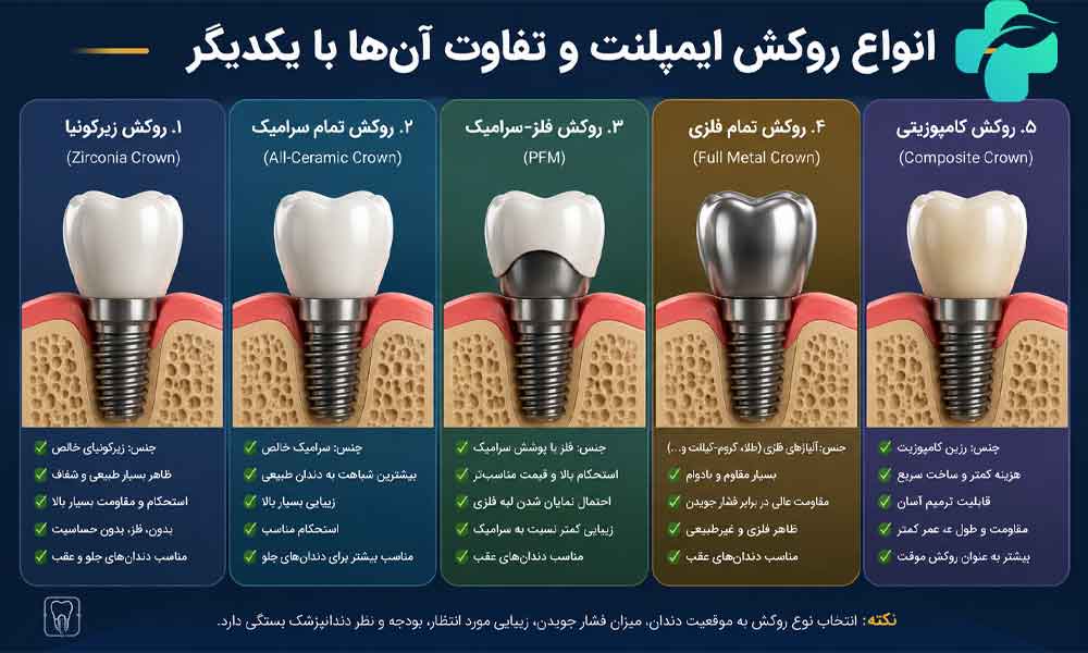 انواع روکش ایمپلنت و تفاوت آن ها با یکدیگر