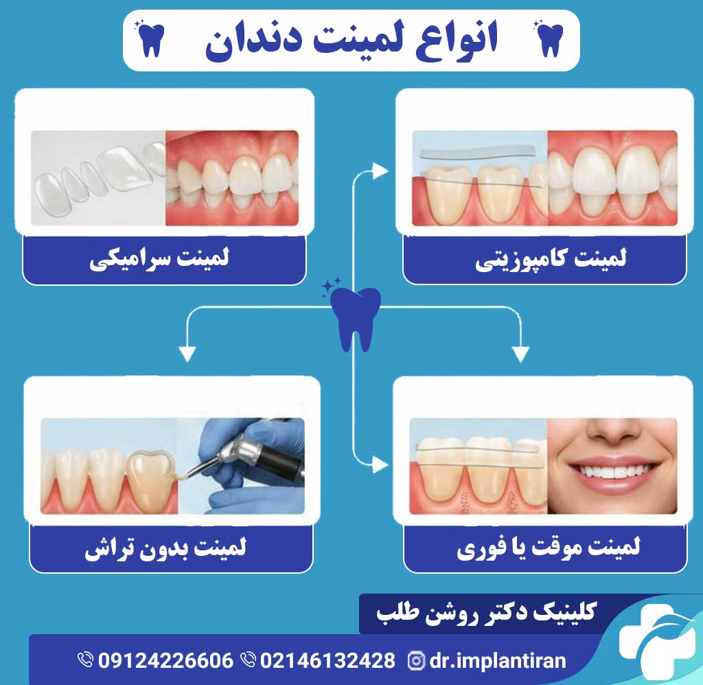 انواع لمینت دندان