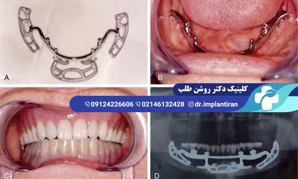 ایمپلنت ساب پریوستیل