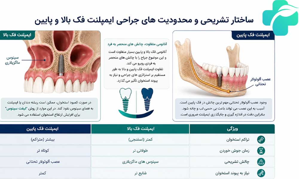 تفاوت ایمپلنت فک بالا و پایین