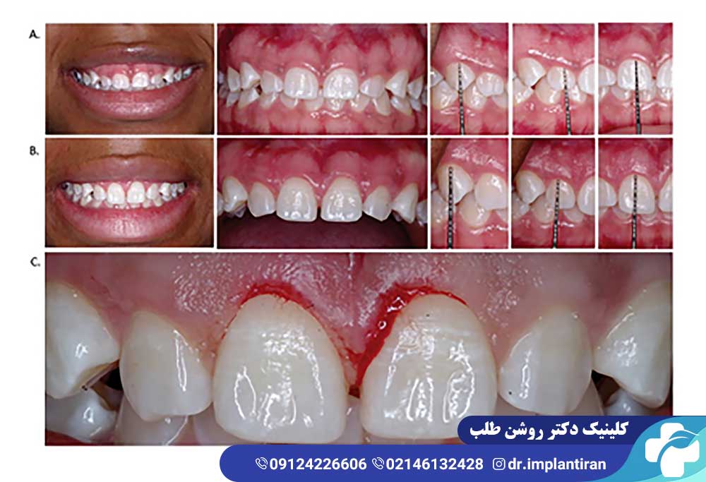 جراحی افزایش طول تاج دندان
