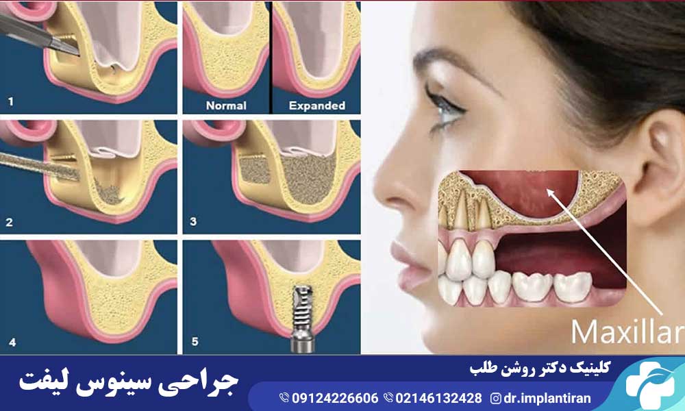 جراحی سینوس لیفت