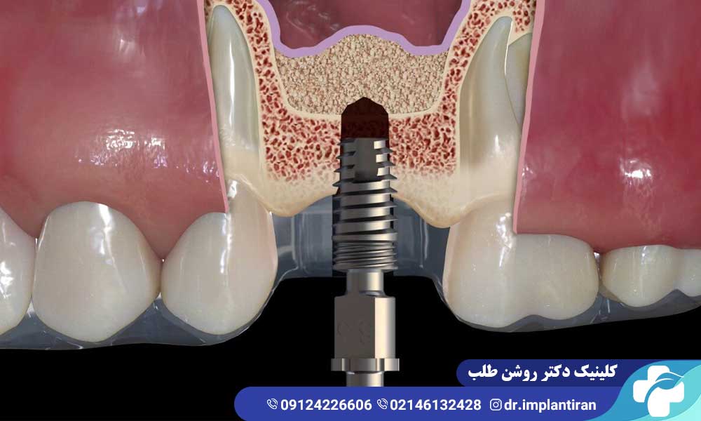 آیا جراحی سینوس لیفت درد دارد؟