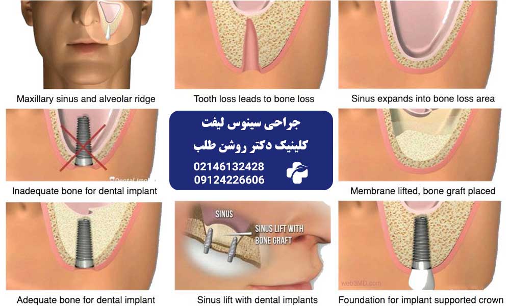 درصد موفقیت جراحی سینوس لیفت چقدر است؟