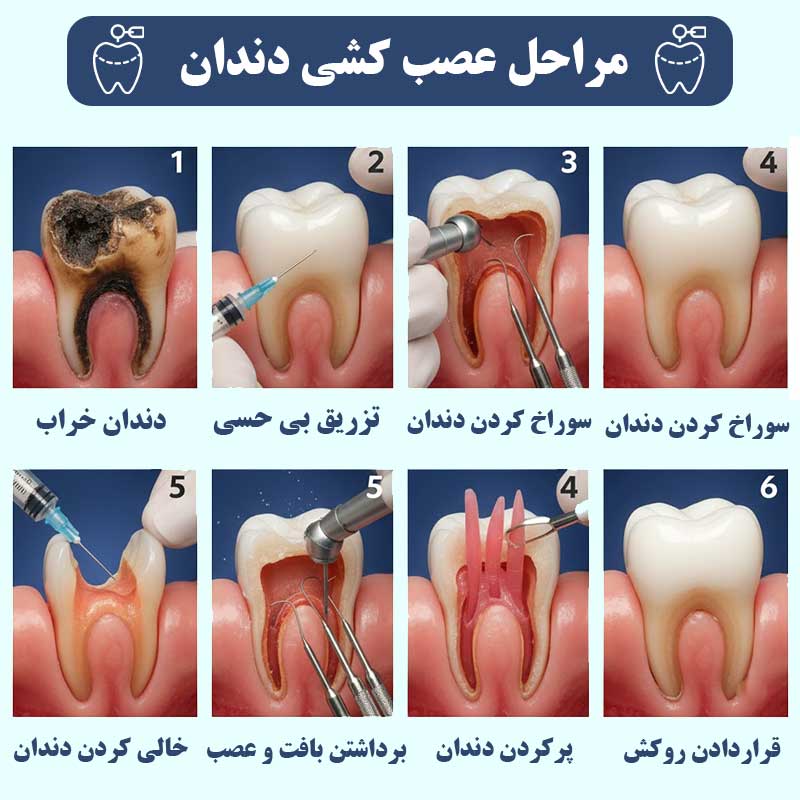 مراحل عصب کشی دندان