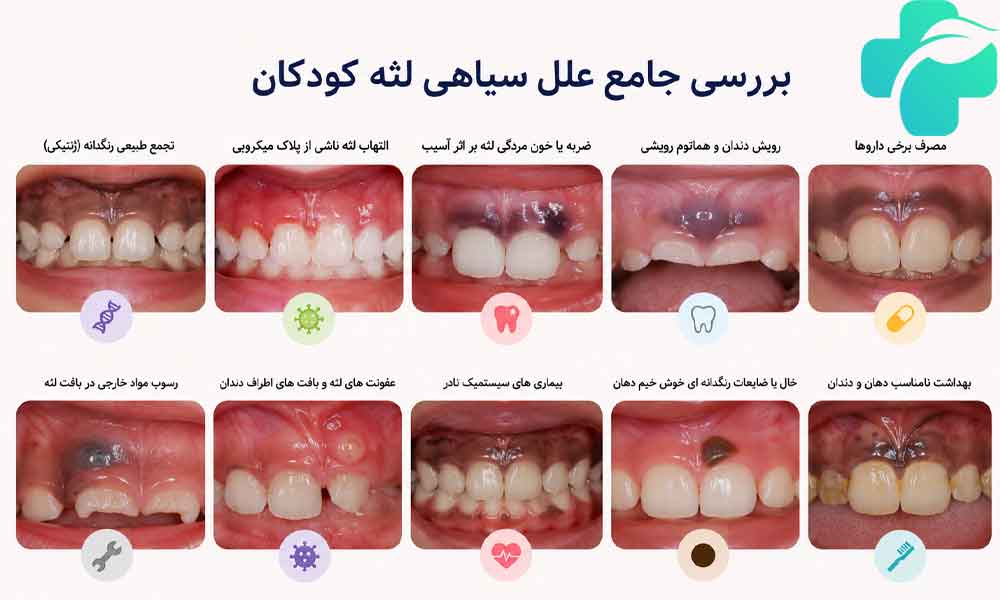 سیاهی لثه کودکان