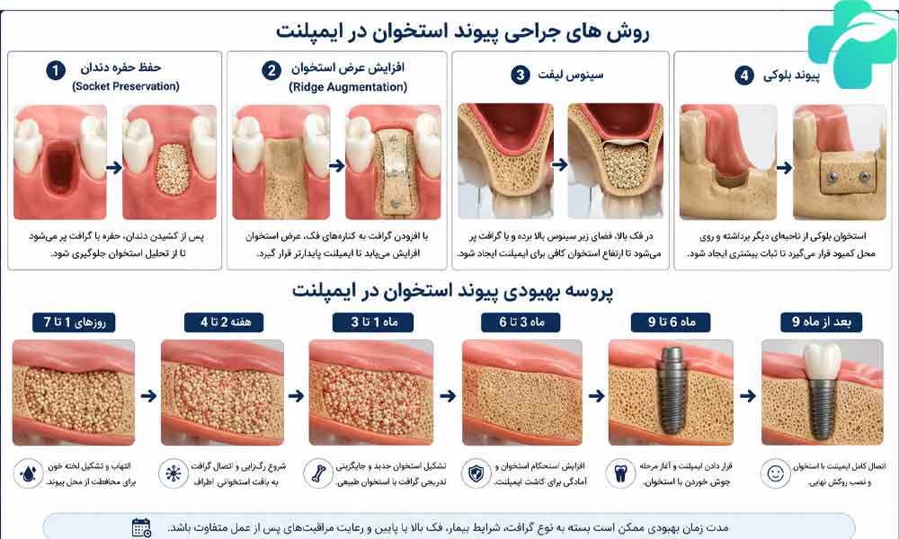 پیوند استخوان در ایمپلنت