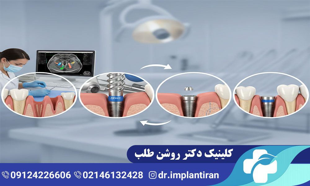 ایمپلنت مگاژن چیست