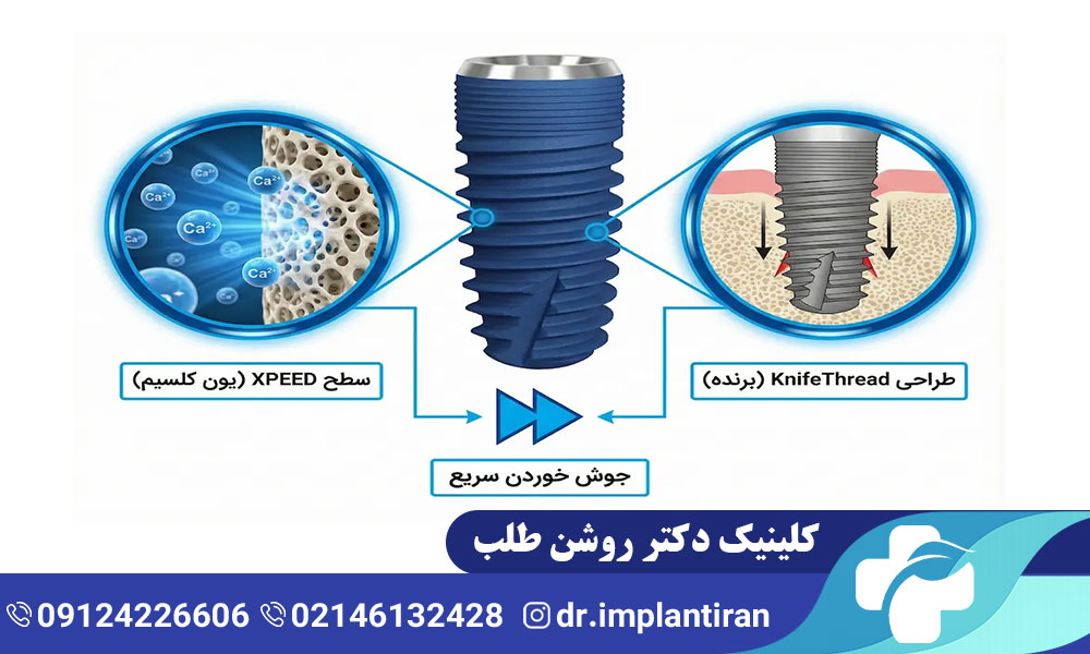 ایمپلنت مگاژن چیست